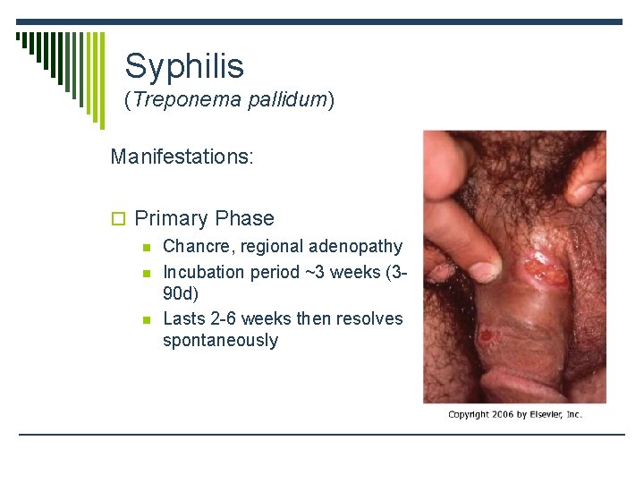 Syphilis (Treponema pallidum) Manifestations: o Primary Phase n Chancre, regional adenopathy n Incubation period