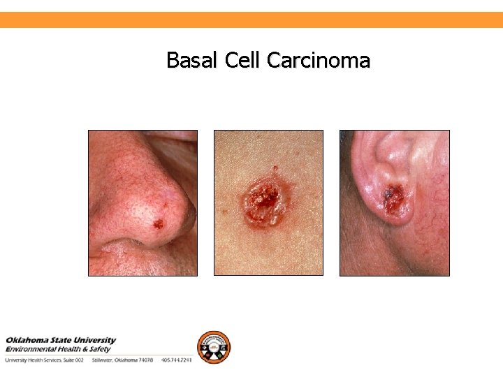 Environmental Health and Safety Basal Cell Carcinoma 