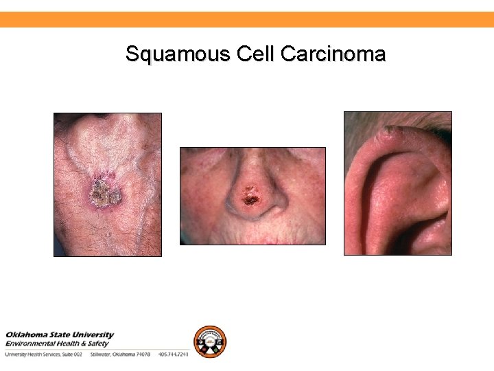 Environmental Health and Safety Squamous Cell Carcinoma 