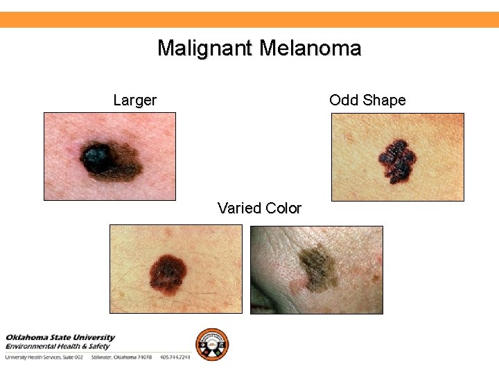 Environmental Health and Safety Malignant Melanoma Larger Odd Shape Varied Color 