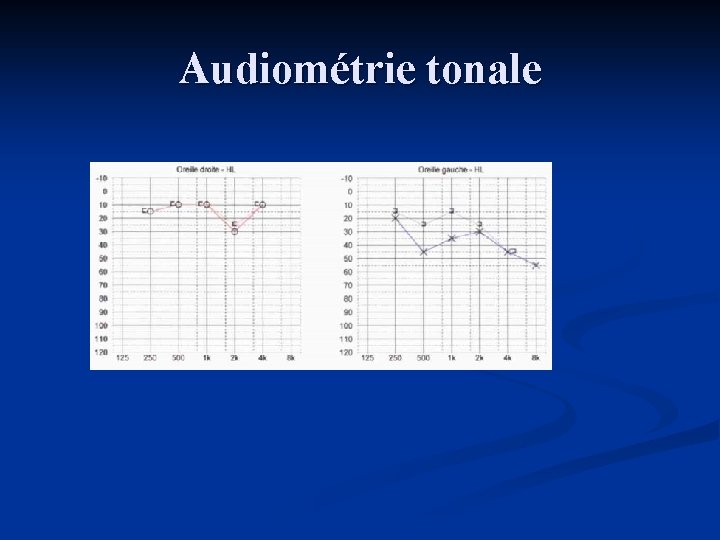 Audiométrie tonale 