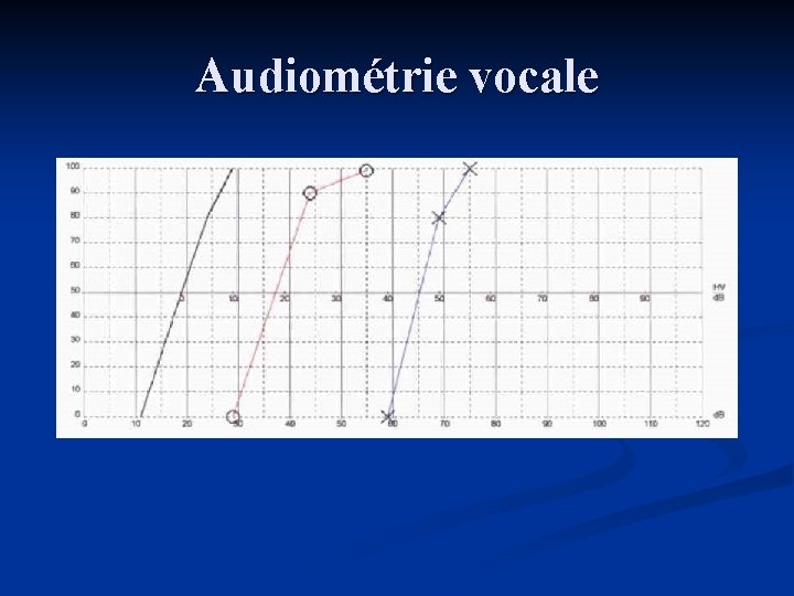 Audiométrie vocale 