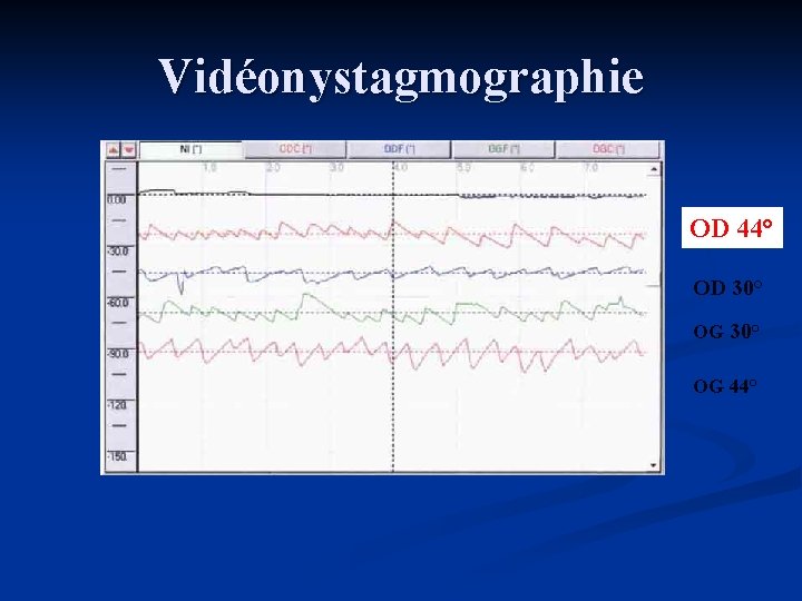 Vidéonystagmographie OD 44° OD 30° OG 44° 