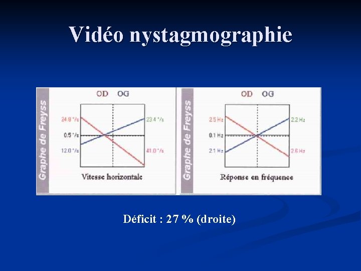Vidéo nystagmographie Déficit : 27 % (droite) 