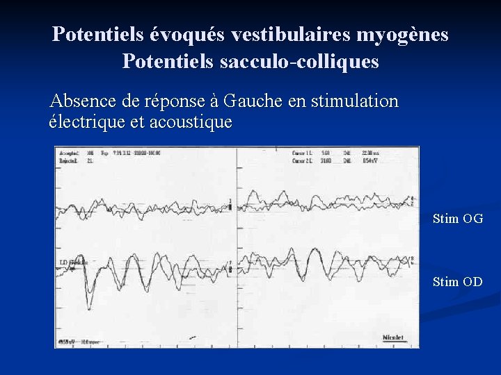 Potentiels évoqués vestibulaires myogènes Potentiels sacculo-colliques Absence de réponse à Gauche en stimulation électrique