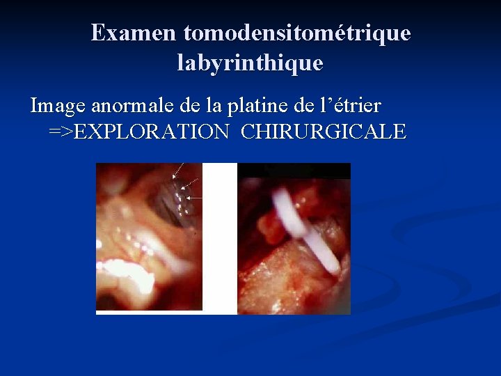 Examen tomodensitométrique labyrinthique Image anormale de la platine de l’étrier =>EXPLORATION CHIRURGICALE 