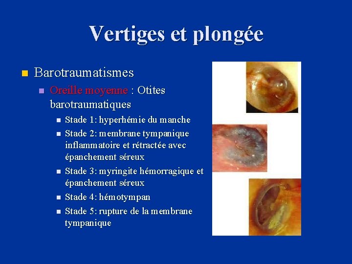 Vertiges et plongée n Barotraumatismes n Oreille moyenne : Otites barotraumatiques n n n