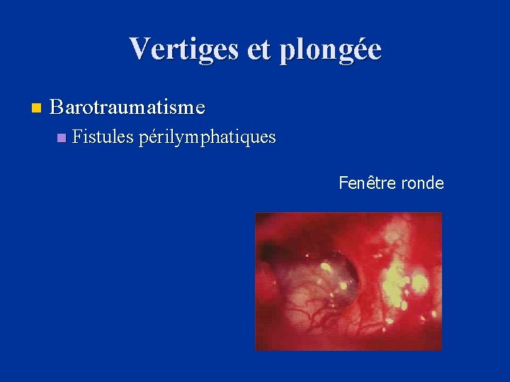 Vertiges et plongée n Barotraumatisme n Fistules périlymphatiques Fenêtre ronde 