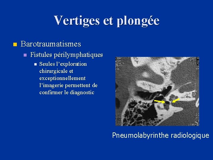 Vertiges et plongée n Barotraumatismes n Fistules périlymphatiques n Seules l’exploration chirurgicale et exceptionnellement