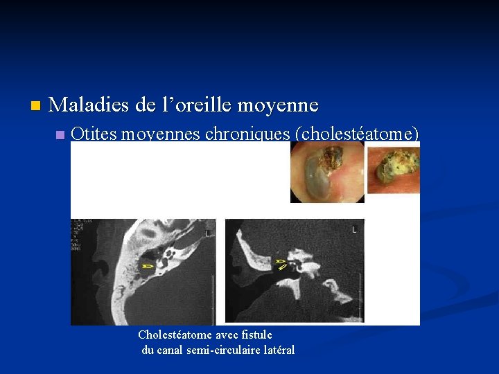 n Maladies de l’oreille moyenne n Otites moyennes chroniques (cholestéatome) Cholestéatome avec fistule du