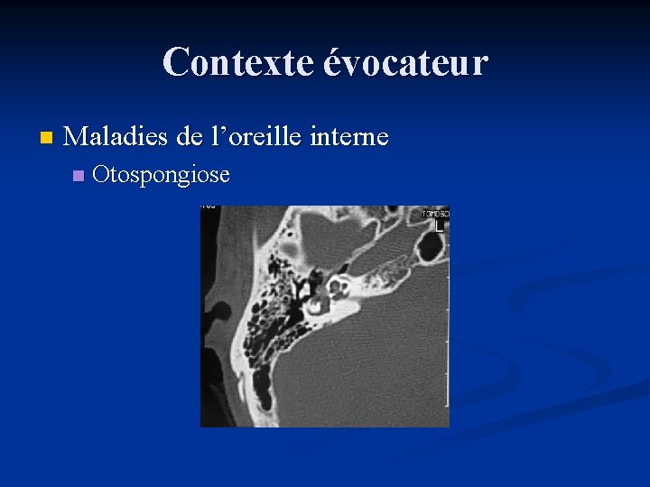 Contexte évocateur n Maladies de l’oreille interne n Otospongiose 