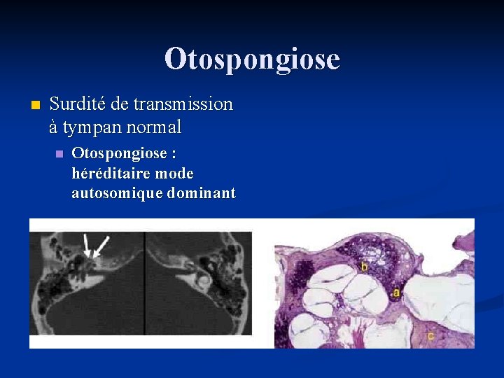Otospongiose n Surdité de transmission à tympan normal n Otospongiose : héréditaire mode autosomique