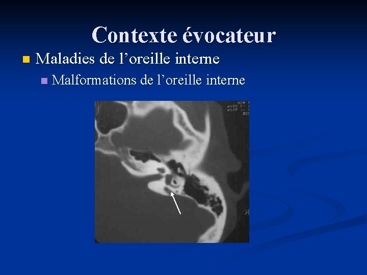 Contexte évocateur n Maladies de l’oreille interne n Malformations de l’oreille interne 
