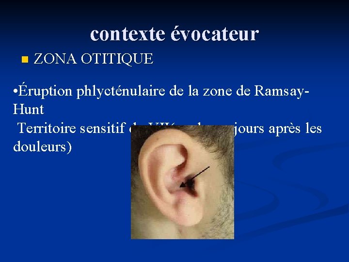 contexte évocateur n ZONA OTITIQUE • Éruption phlycténulaire de la zone de Ramsay. Hunt