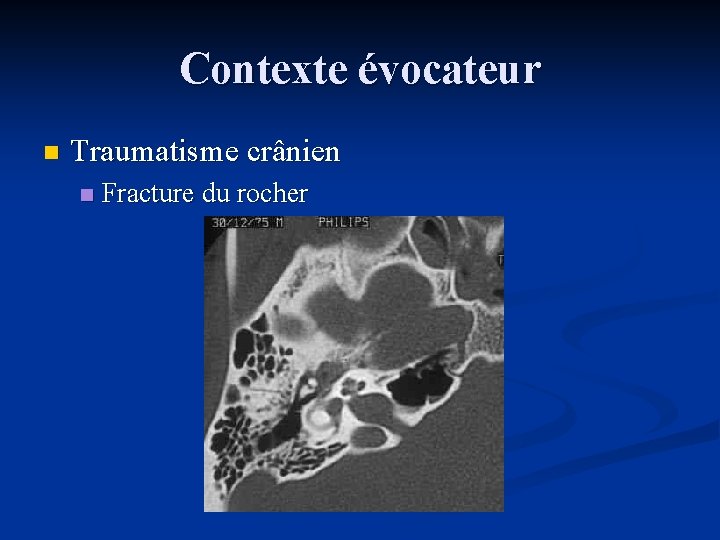 Contexte évocateur n Traumatisme crânien n Fracture du rocher 