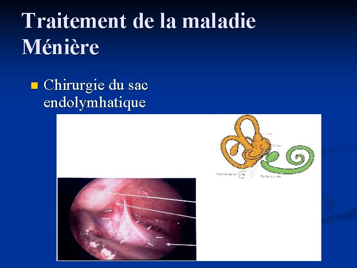 Traitement de la maladie Ménière n Chirurgie du sac endolymhatique 