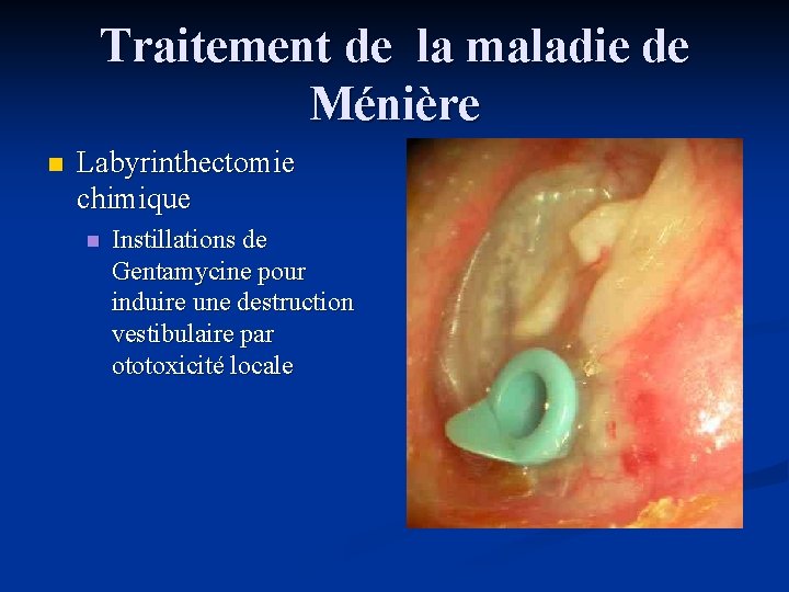 Traitement de la maladie de Ménière n Labyrinthectomie chimique n Instillations de Gentamycine pour