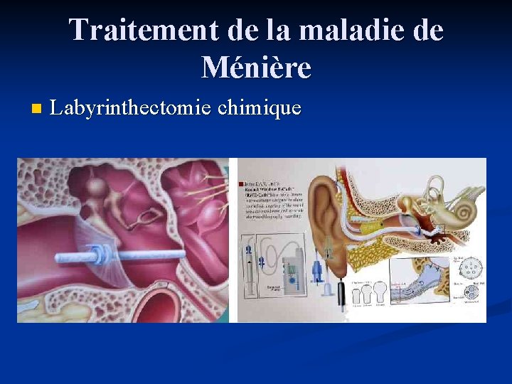 Traitement de la maladie de Ménière n Labyrinthectomie chimique 