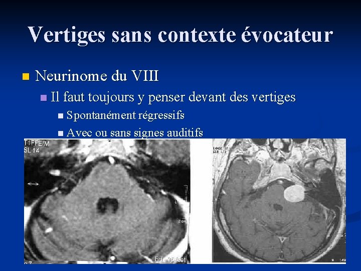 Vertiges sans contexte évocateur n Neurinome du VIII n Il faut toujours y penser