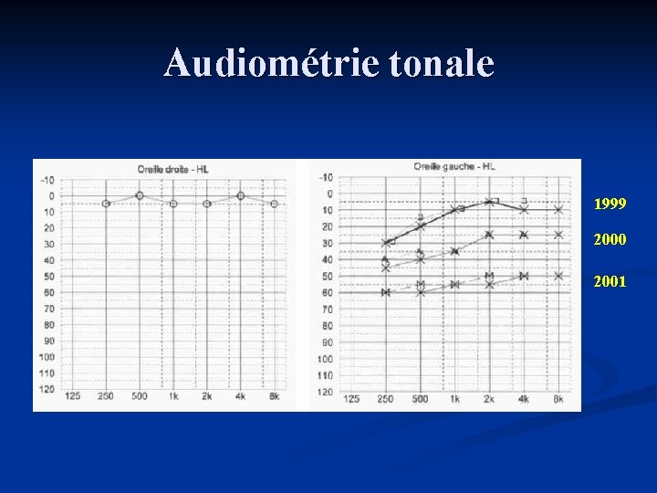 Audiométrie tonale 1999 2000 2001 