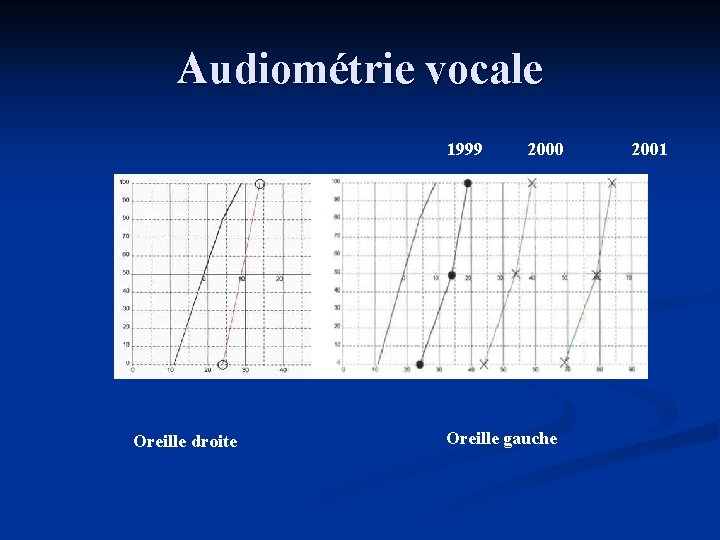 Audiométrie vocale 1999 Oreille droite 2000 Oreille gauche 2001 