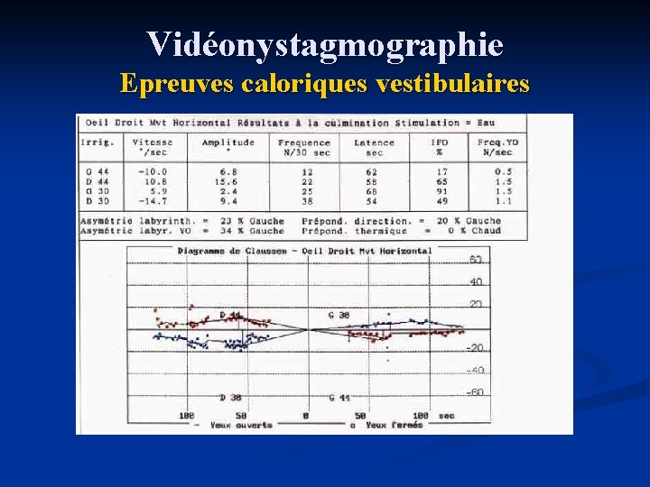 Vidéonystagmographie Epreuves caloriques vestibulaires 
