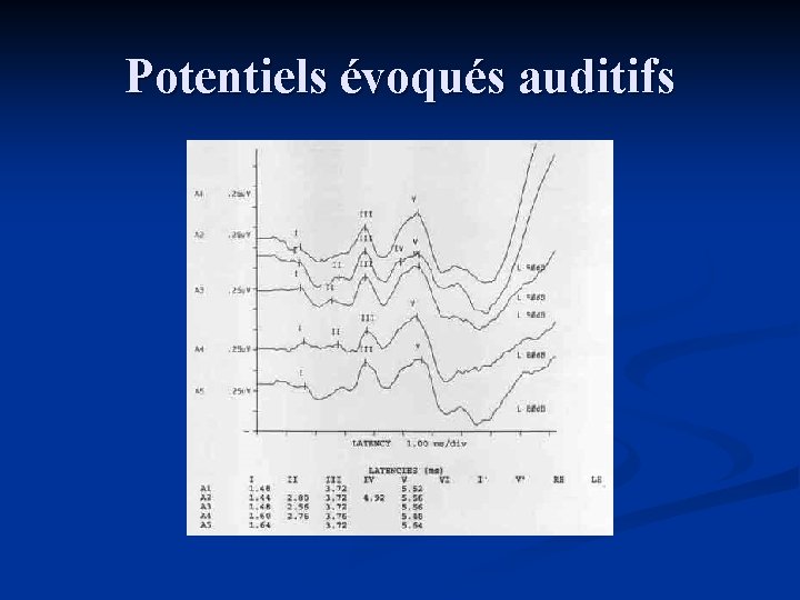 Potentiels évoqués auditifs 