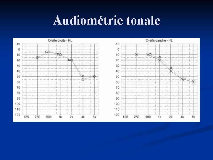 Audiométrie tonale 