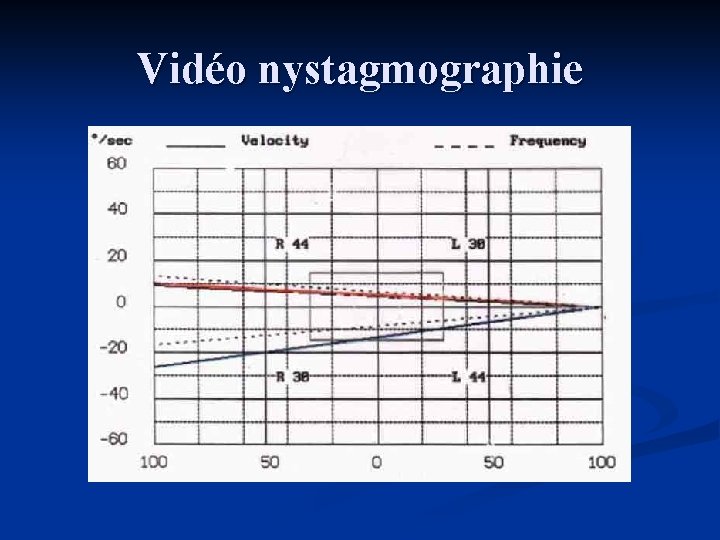 Vidéo nystagmographie 
