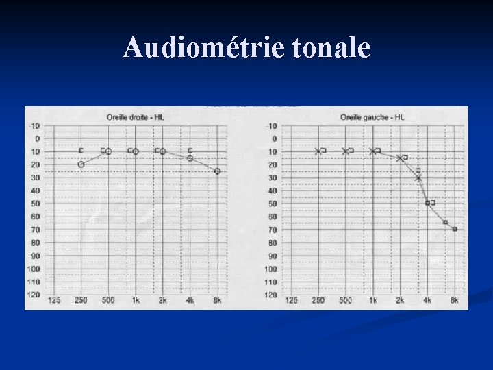 Audiométrie tonale 