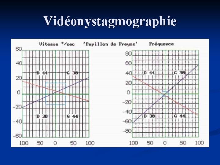Vidéonystagmographie 