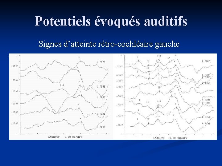 Potentiels évoqués auditifs Signes d’atteinte rétro-cochléaire gauche Temps de latence ondes V : 6,