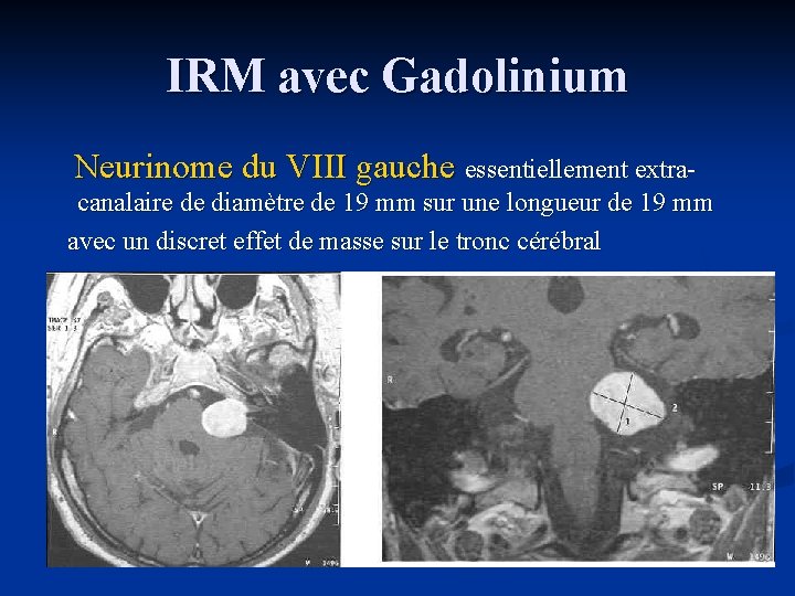 IRM avec Gadolinium Neurinome du VIII gauche essentiellement extracanalaire de diamètre de 19 mm