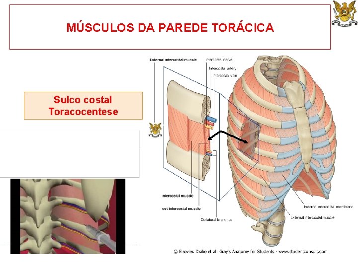 MÚSCULOS DA PAREDE TORÁCICA Sulco costal Toracocentese 