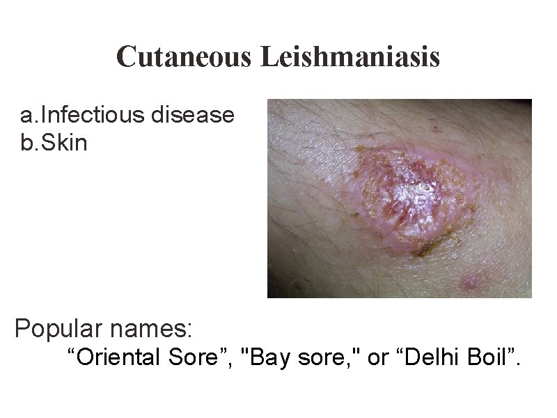 Cutaneous Leishmaniasis a. Infectious disease b. Skin Popular names: “Oriental Sore”, "Bay sore, "