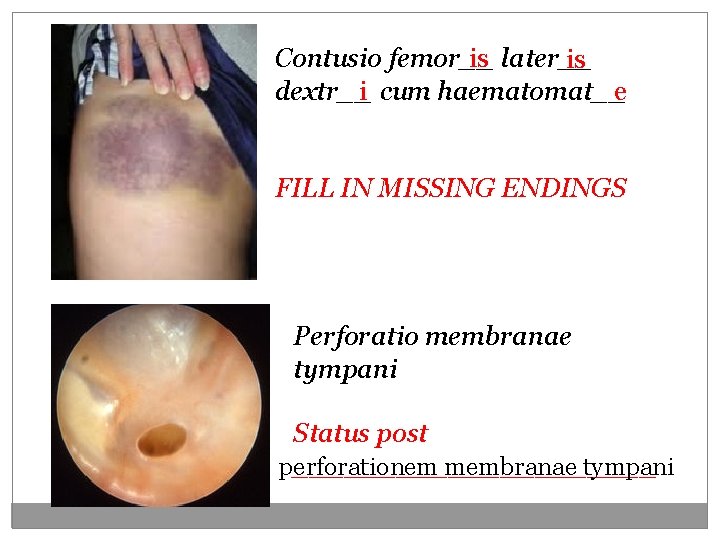 Contusio femor__ is later__ is dextr__ i cum haematomat__e FILL IN MISSING ENDINGS Perforatio