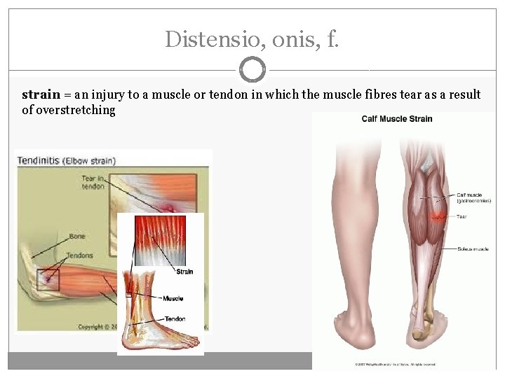 Distensio, onis, f. strain = an injury to a muscle or tendon in which