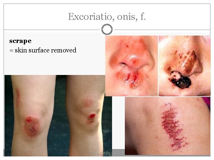Excoriatio, onis, f. scrape = skin surface removed 