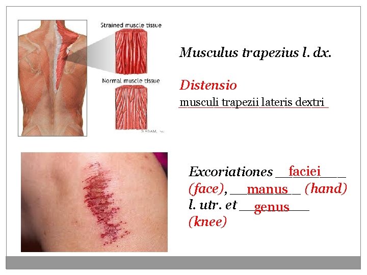 Musculus trapezius l. dx. Distensio musculi trapezii lateris dextri _________ faciei Excoriationes ____ (face),