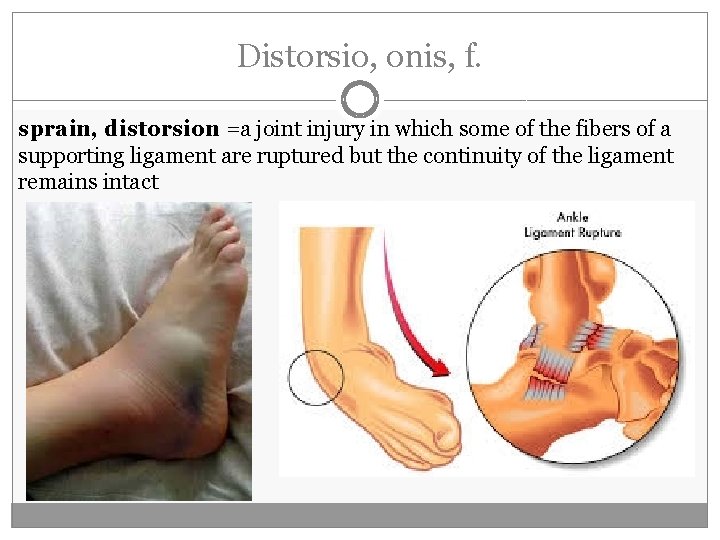 Distorsio, onis, f. sprain, distorsion =a joint injury in which some of the fibers