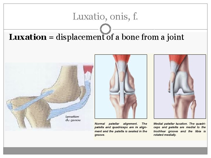 Luxatio, onis, f. Luxation = displacement of a bone from a joint 