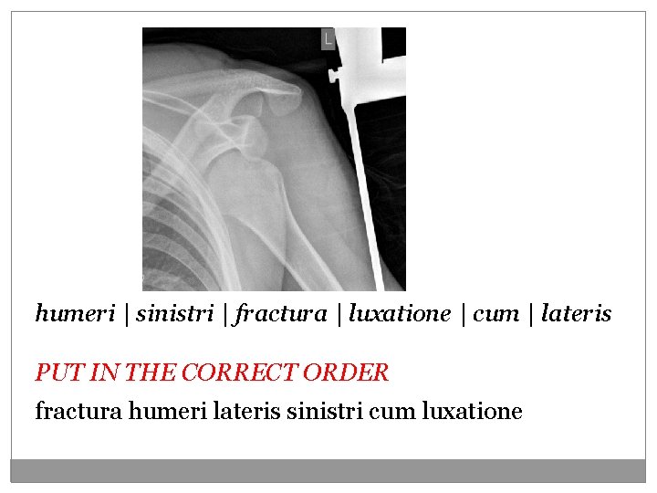 humeri | sinistri | fractura | luxatione | cum | lateris PUT IN THE