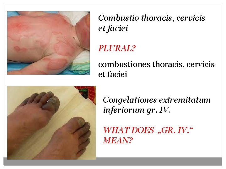Combustio thoracis, cervicis et faciei PLURAL? combustiones thoracis, cervicis et faciei Congelationes extremitatum inferiorum