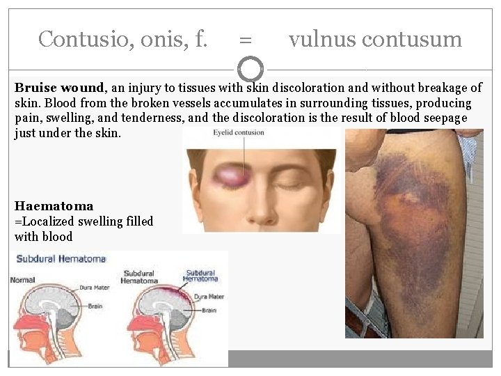 Contusio, onis, f. = vulnus contusum Bruise wound, an injury to tissues with skin