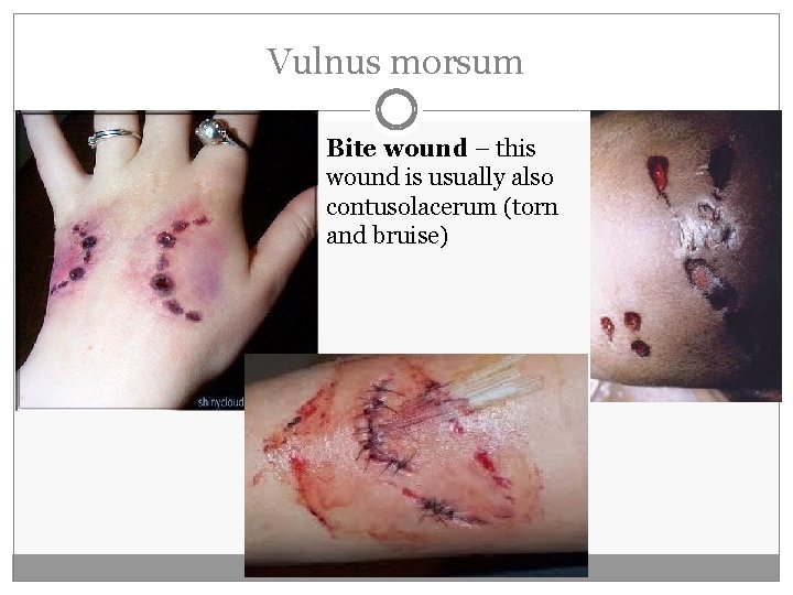 Vulnus morsum Bite wound – this wound is usually also contusolacerum (torn and bruise)