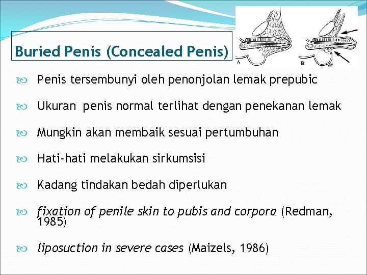 Buried Penis (Concealed Penis) Penis tersembunyi oleh penonjolan lemak prepubic Ukuran penis normal terlihat