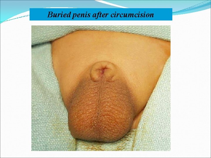 Buried penis after circumcision 