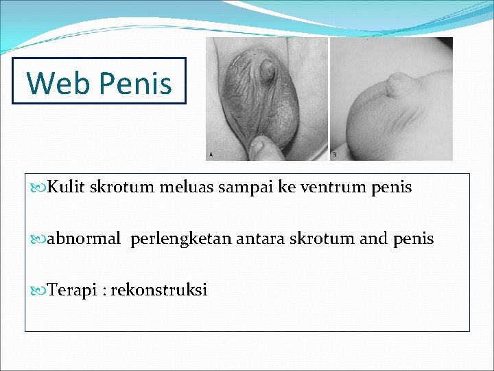 Web Penis Kulit skrotum meluas sampai ke ventrum penis abnormal perlengketan antara skrotum and