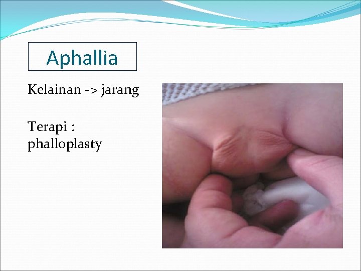 Aphallia Kelainan -> jarang Terapi : phalloplasty 