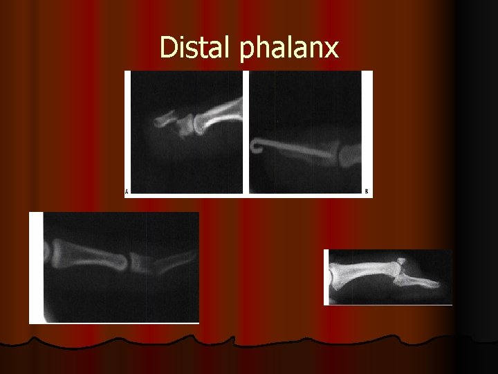 Distal phalanx 